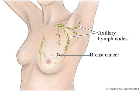 Cluster of axillary lymph nodes in underarm area and upper part of breast, showing an area of cancer in breast.