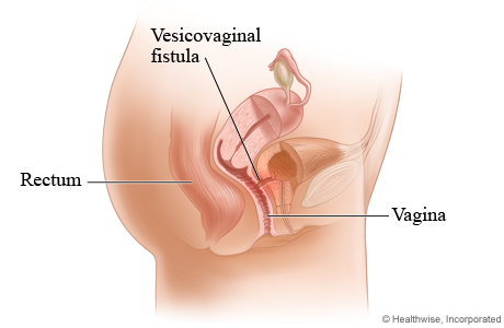 Picture of a vesicovaginal fistula