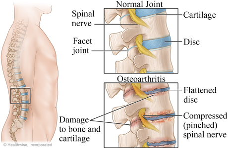 Normal spine and osteoarthritis of the spine