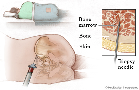 Bone marrow aspiration and biopsy.