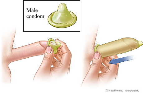 Male condom being unrolled over an erect penis