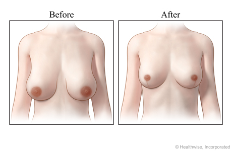 Views of breasts, before and after a breast reduction.
