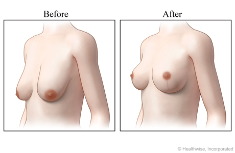 Views of breasts, before and after a breast lift