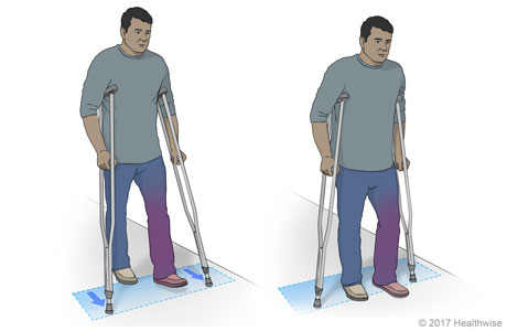 Person walking with crutches moving the weaker leg and crutches at the same time, followed by the other leg.