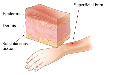 Cross section of skin showing burn in epidermis layer of skin on lower arm.