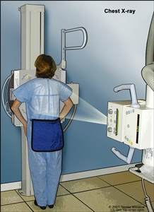 Chest x-ray; drawing shows a patient standing with their back to the x-ray machine. X-rays pass through the patient's body onto film or a computer and take pictures of the structures and organs inside the chest.