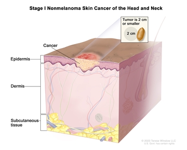 Stage I nonmelanoma skin cancer of the head and neck; drawing shows cancer in the epidermis (the outer layer of the skin). An inset shows that the tumor is 2 centimeters or smaller and that 2 centimeters is about the size of a peanut. Also shown are the dermis (the inner layer of the skin) and the subcutaneous tissue below the dermis.