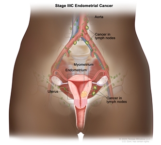 Stage IIIC endometrial cancer; drawing shows cancer in the endometrium and myometrium of the uterus. Also shown is cancer in lymph nodes in the pelvis and near the aorta.
