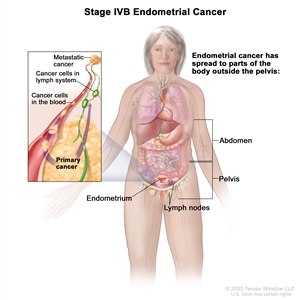 Stage IVB endometrial cancer; drawing shows cancer that has spread to parts of the body outside the pelvis, including the abdomen and lymph nodes in the groin. An inset shows cancer cells spreading from the endometrium, through the blood and lymph system, to another part of the body where metastatic cancer has formed.