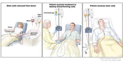 Donor stem cell transplant; (Panel 1): Drawing of stem cells being collected from a donor's bloodstream using an apheresis machine. Blood is removed from a vein in the donor's arm and flows through the machine where the stem cells are removed. The rest of the blood is then returned to the donor through a vein in their other arm. (Panel 2): Drawing of a health care provider giving a patient an infusion of chemotherapy through a catheter in the patient's chest. The chemotherapy is given to kill cancer cells and prepare the patient's body for the donor stem cells. (Panel 3): Drawing of a patient receiving an infusion of the donor stem cells through a catheter in the chest.