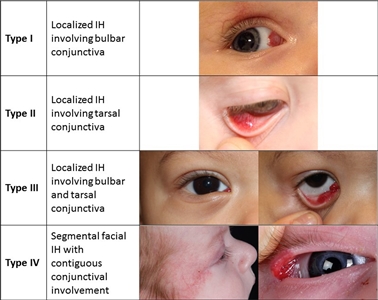Photographs showing different types of infantile hemangiomas involving the conjunctiva.