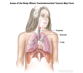 Drawing shows areas of the body where tracheobronchial tumors may form, including the trachea and the bronchi (large airways of the lung).