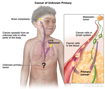 Cancer of unknown primary; drawing shows a primary tumor that has spread from an unknown site to other parts of the body (the lung and the brain). An inset shows cancer cells spreading from the primary cancer, through the blood and lymph systems, to another part of the body where a metastatic tumor has formed.