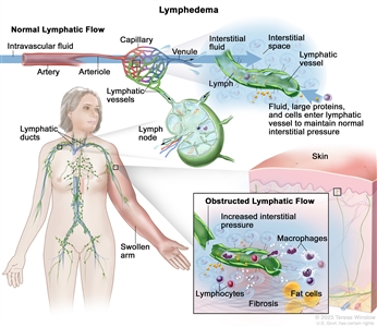 Lymphedema; the top part of the drawing shows normal lymphatic flow. An arrow is used to show intravascular fluid flowing through an artery, an arteriole, and a capillary bed, where the fluid leaks out into the interstitial space around the cells and then exits through the venules. Also shown is interstitial fluid, large proteins, and cells entering a lymphatic vessel to maintain normal interstitial pressure. The fluid in the lymphatic vessel is called lymph. Also shown is the inside structure of a lymph node attached to the lymphatic vessel with arrows showing how the lymph moves into and out of the lymph node. The lymphatic ducts in the neck area of a female figure are also shown. The figure's left arm is red and swollen. There is a pull-out from the swollen arm showing a top layer of red, hardened skin and an inset box showing obstructed lymphatic flow. A damaged lymphatic vessel resulting in increased interstitial pressure and a build-up of large proteins, cellular debris, macrophages, and lymphocytes are shown. Large fat cells and fibrosis are also shown in the inset box.