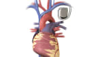 Pacemaker Placement: Before Your Procedure